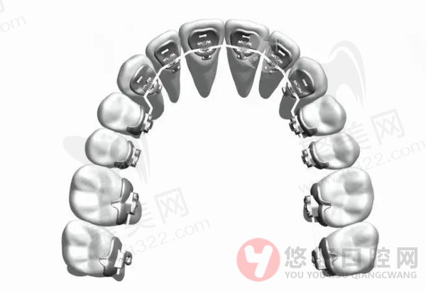 舌侧矫正的优势有哪些