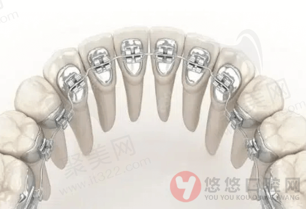 影响舌侧矫正治疗周期的因素