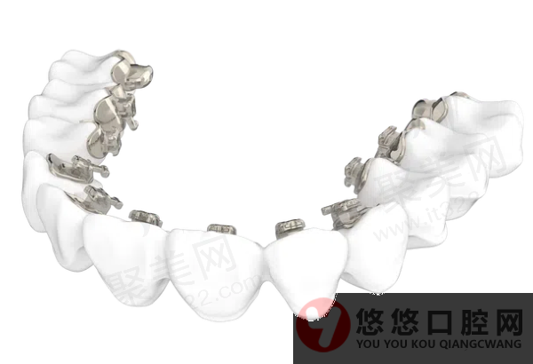 如何缩短舌侧矫正的治疗周期