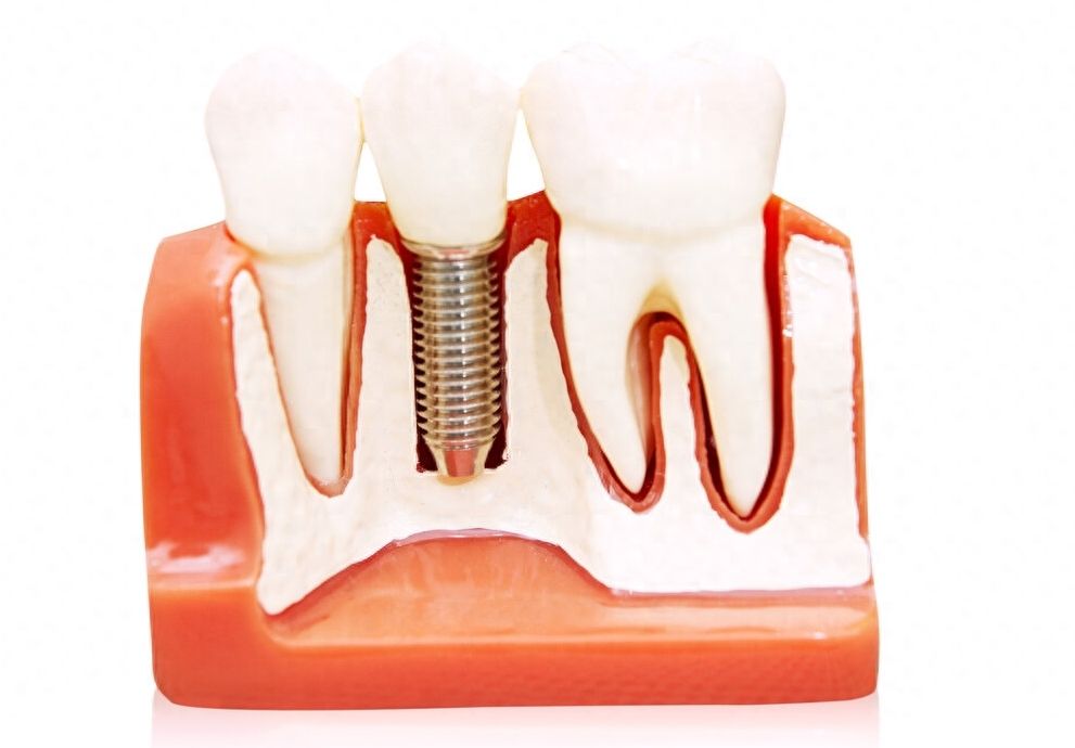 马鞍山种植牙价格降至3700元以下，鼎植、牙百佳价格曝光【2024年最新】