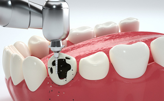 江苏徐州牙知道口腔连锁价格表：洗牙100元起，树脂补牙300元起，智齿拔牙400