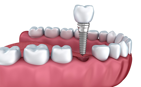 太可了！2024新版南京种植牙医院榜单+南京种植牙价格重新公开，种牙2100元起