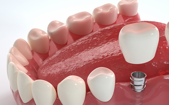 2025 江苏满口牙种植多少钱？茀莱堡 / 苏州美奥等 6 家医院价格表 + 全