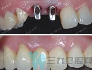 常州牙科医院2025六大排名安利,种植牙价格超赞的牙科请get