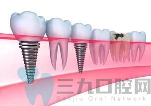 2025合肥种植牙排名前十的口腔医院公开啦！亦是正规价格靠谱的口腔医院